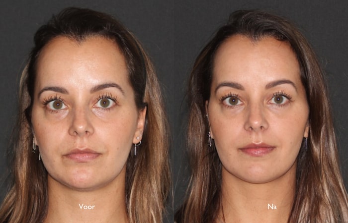 fillers onder ogen